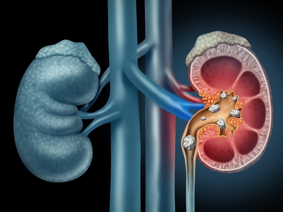 5 Hábitos Diários para Prevenir Cálculos Renais
